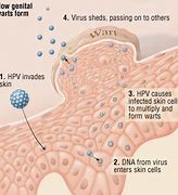 Image result for Male Genital Warts Disease