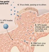Image result for Male Genital Warts Stages