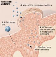 Image result for HPV Genital Warts Disease