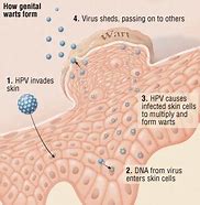 Image result for Human Papillomaviru Genital Warts