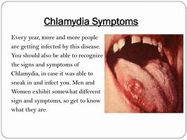 Image result for Chlamydia of Mouth