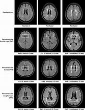 Image result for Fazekas WMH Perivascular Subcortical