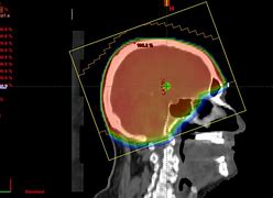 Image result for Whole Brain Radiation