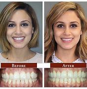 Image result for SRP Dental Before and After