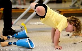 Image result for Child Wihout Foot