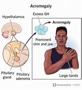 Image result for Acromegaly