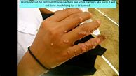 Image result for Removing Warts On Hands