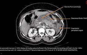 Image result for Pancreas Tail CT AP Pancreatitis