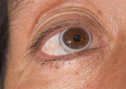 Image result for Weird Grey Ring around My Iris