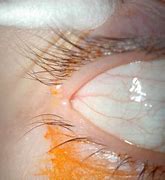 Image result for Molluscum Removal On Eye