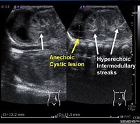 Image result for Anechoic Cyst Kidney