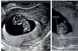 Image result for Placenta On Ultrasound 8 Weeks