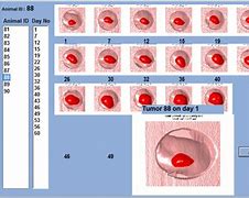 Image result for How Big Is a 20 Cm Tumor