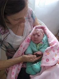 Image result for Acrania Anencephaly