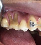 Image result for Gum Recession in Molar