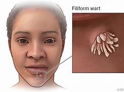 Image result for Filiform Wart Nose