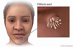 Image result for Filiform Wart On Forehead