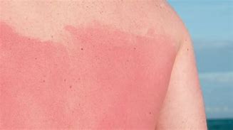 Image result for Hilarious Severe Sunburn