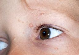 Image result for Contagious Molluscum Children Eye