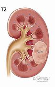 Image result for 4 Cm Mass On Kidney