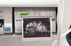 Image result for Th 400 Portable Ultrasound Machine and Sony Printer