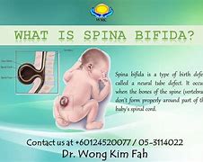 Image result for Signs of Spina Bifida
