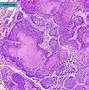 Image result for Microbiology Squamous Cell Carcinoma Lung