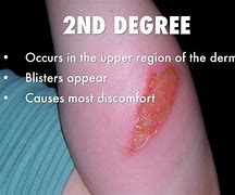 Image result for Small 2nd Degree Burn