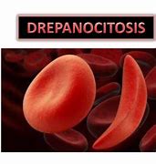 Image result for drepanocitosis