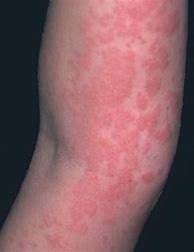 Image result for Skin Rashes Allergies