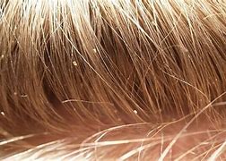 Image result for What Does Head Lice Look Like