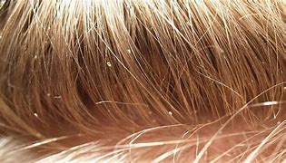 Image result for What Does Lice Look Like in Hair