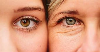 Image result for blefaroplastia