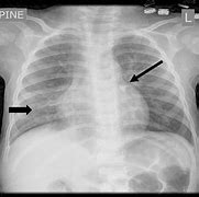 Image result for Calcified Lung Nodules