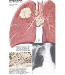 Image result for Large Cell Lung Cancer