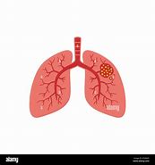 Image result for Lung Cancer Clip Art