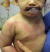 Image result for Baby Skin Rash On Face
