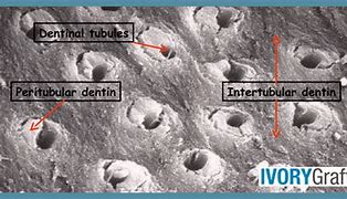 Image result for Intratubular Dentin