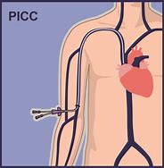 Image result for PICC Line Picture End Tip