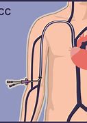 Image result for PICC Line Catheter Placement