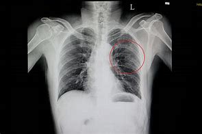Image result for Broken Ribs Symptoms