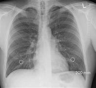 Image result for Collapsed Lung On X-ray
