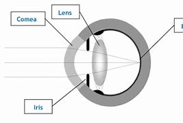 Image result for Refractive Single Focus Surgery