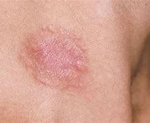 Image result for Leukemia Skin Symptoms