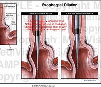 Image result for Esophageal Dilation