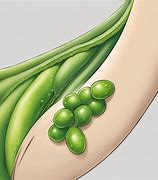 Image result for Pea Sized Lump in Armpit