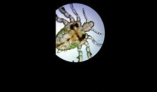 Image result for Crabs STD Under Microscope