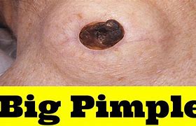 Image result for How Big Is 4Mm Cyst