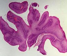 Image result for Uvula Papilloma
