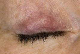 Image result for Meibomian Cyst